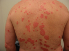 can methotrexate cause skin itching
